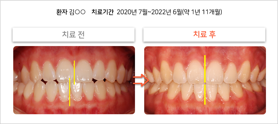 비대칭 교정 케이스07